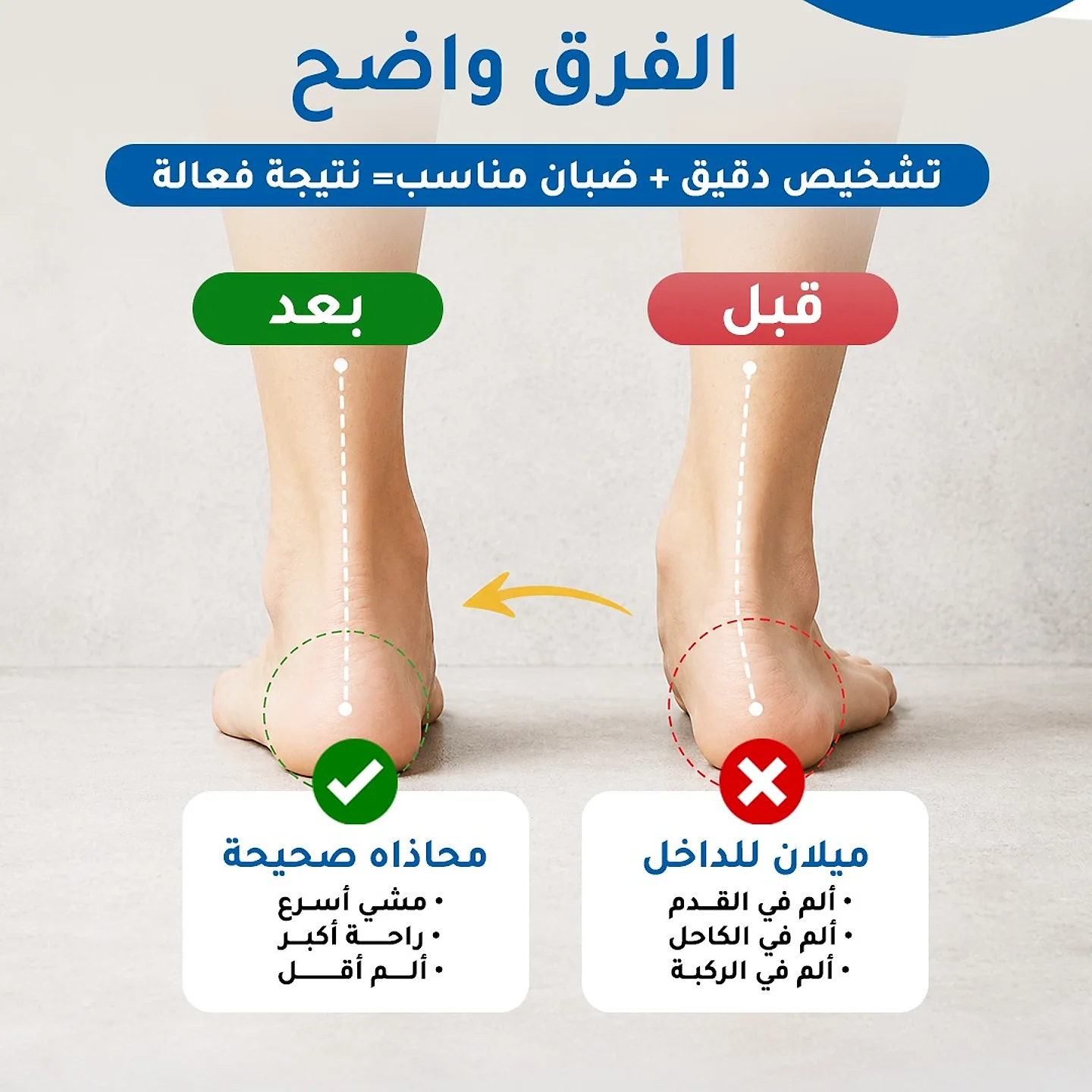 الفحص المحوسب للقدم المسطحة