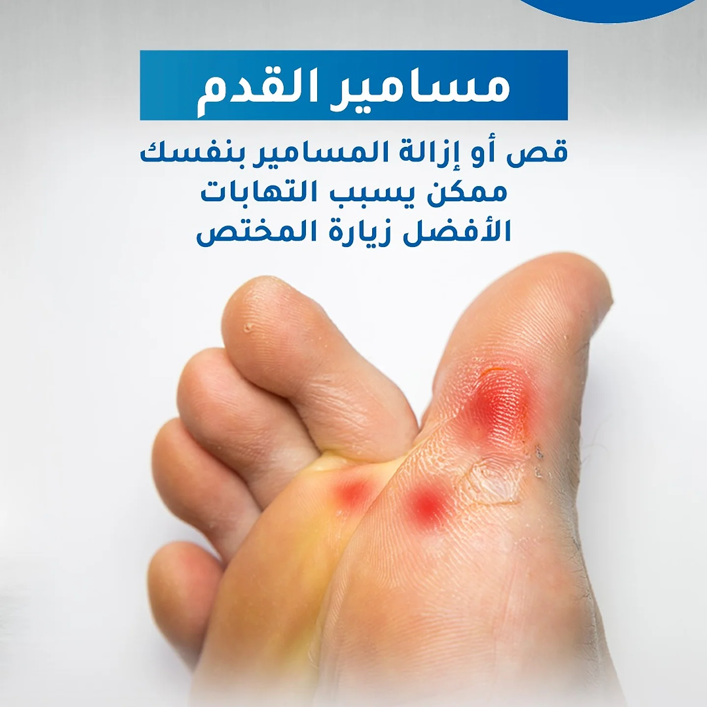 مسامير اللحم والجلد المتصلّب