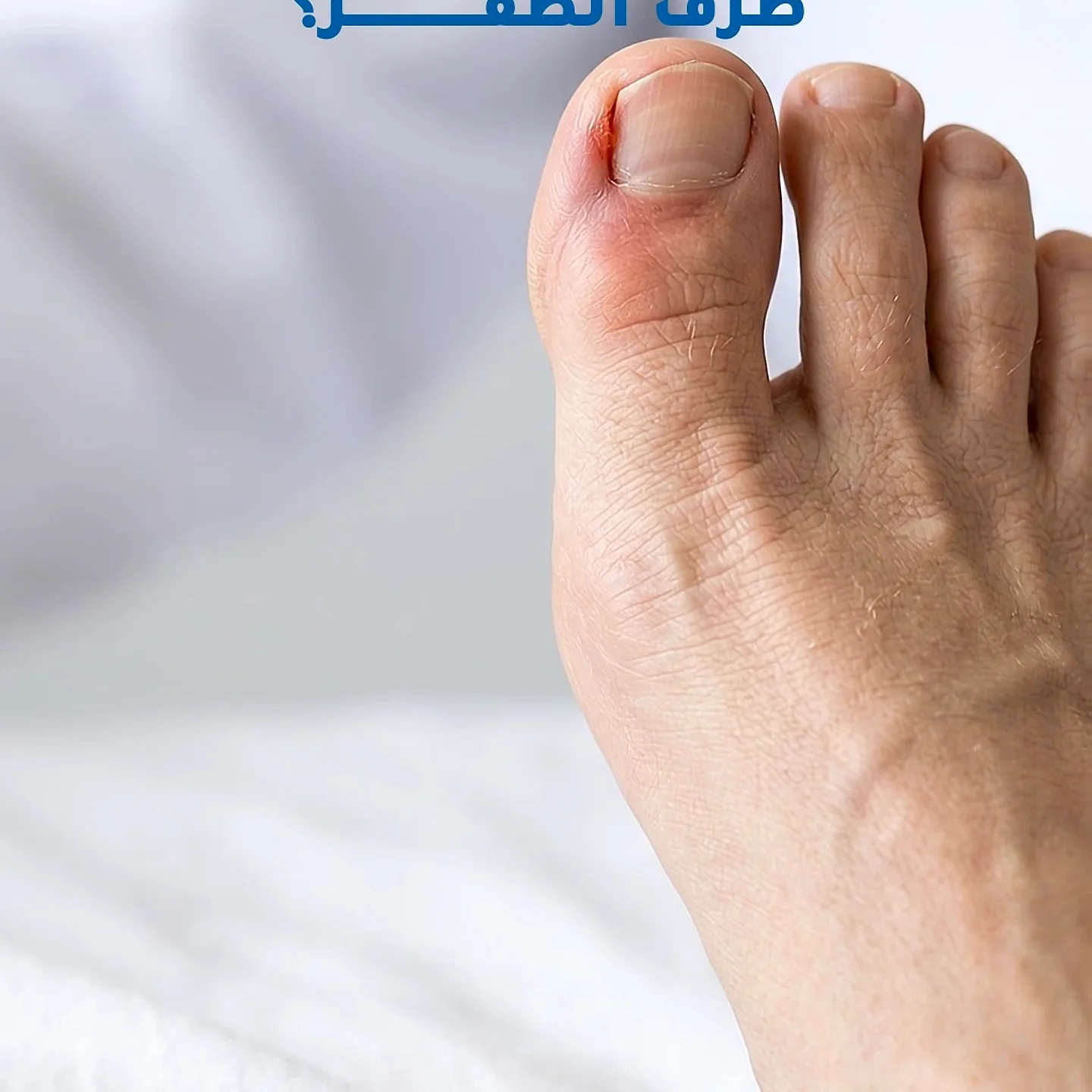 علاج فطريات الأظافر