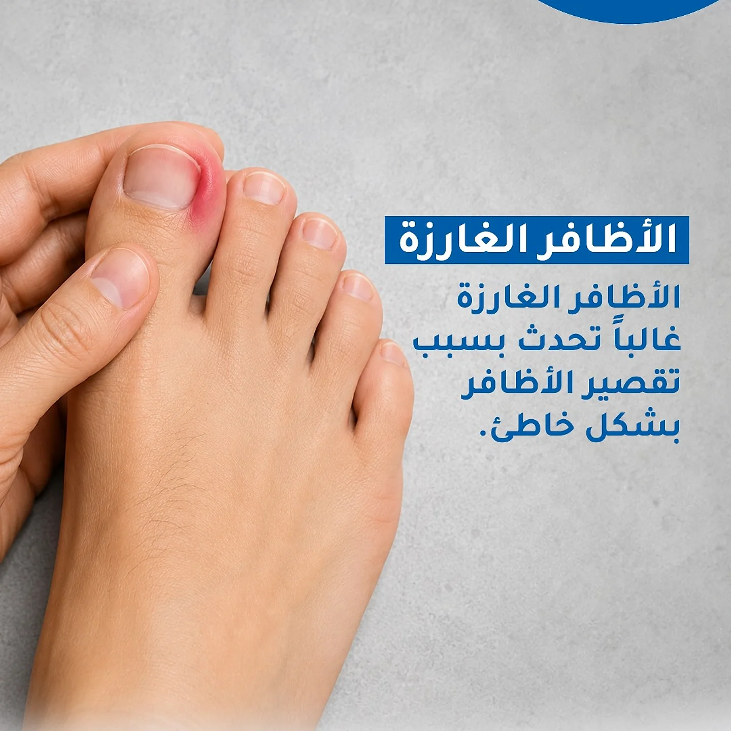 علاج الأظافر الغارزة